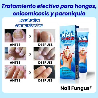 Nail Fungus® | Crema Anti Hongos para Uñas y Pies