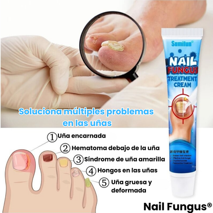 Nail Fungus® | Crema Anti Hongos para Uñas y Pies