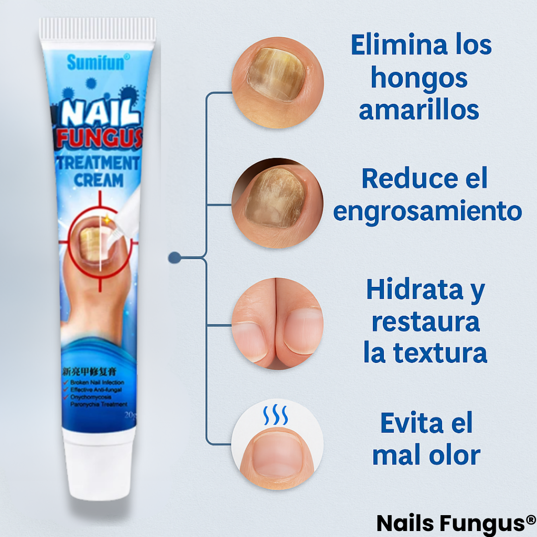 Nail Fungus® | Crema Anti Hongos para Uñas y Pies